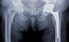 Hip replacements and other orthopaedic implants