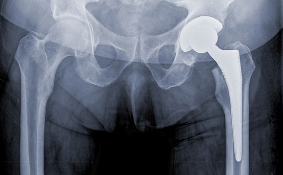 Hip replacements and other orthopaedic implants Hip replacements and other orthopaedic implants