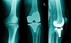 Knee replacements