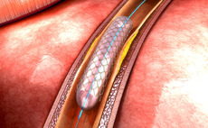 Coronary stents and heart disease