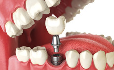Dental implants and dentures